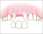 従来法：失った歯の両隣の歯を削ってブリッジにします。