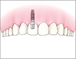 両隣の健康な歯を削らずに固定された人工の歯を入れることが出来ます。