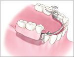 従来法：他の歯にバネをかけて部分入れ歯を固定します。