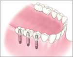 他の歯にバネをかけることなく固定された人工の歯を入れることが出来ます。