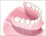 従来法：歯肉との吸着力で入れ歯を支えます。
