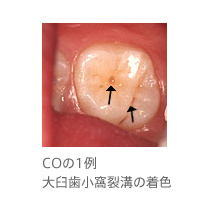 COの1例、大臼歯小窩裂溝の着色