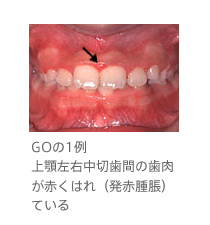 GOの1例、上顎左右中切歯間の歯肉が赤くはれ（発赤腫脹）ている