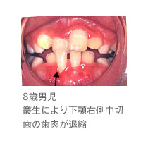 8歳男児、叢生により下顎右側中切歯の歯肉が退縮