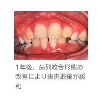 1年後、歯列咬合形態の改善により歯肉退縮が緩和