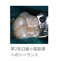 第2乳臼歯小窩裂溝へのシーラント