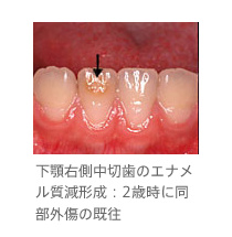 下顎右側中切歯のエナメル質減形成：2歳時に同部外傷の既往