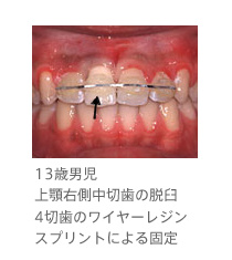 13歳男児、上顎右側中切歯の脱臼、4切歯のワイヤーレジンスプリントによる固定