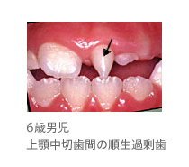 6歳男児、上顎中切歯間の順生過剰歯