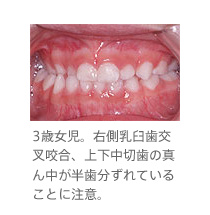 3歳女児。右側乳臼歯交叉咬合、上下中切歯の真ん中が半歯分ずれていることに注意。