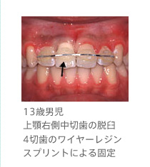 13歳男児／上顎右側中切歯の脱臼　4切歯のワイヤーレジンスプリントによる固定